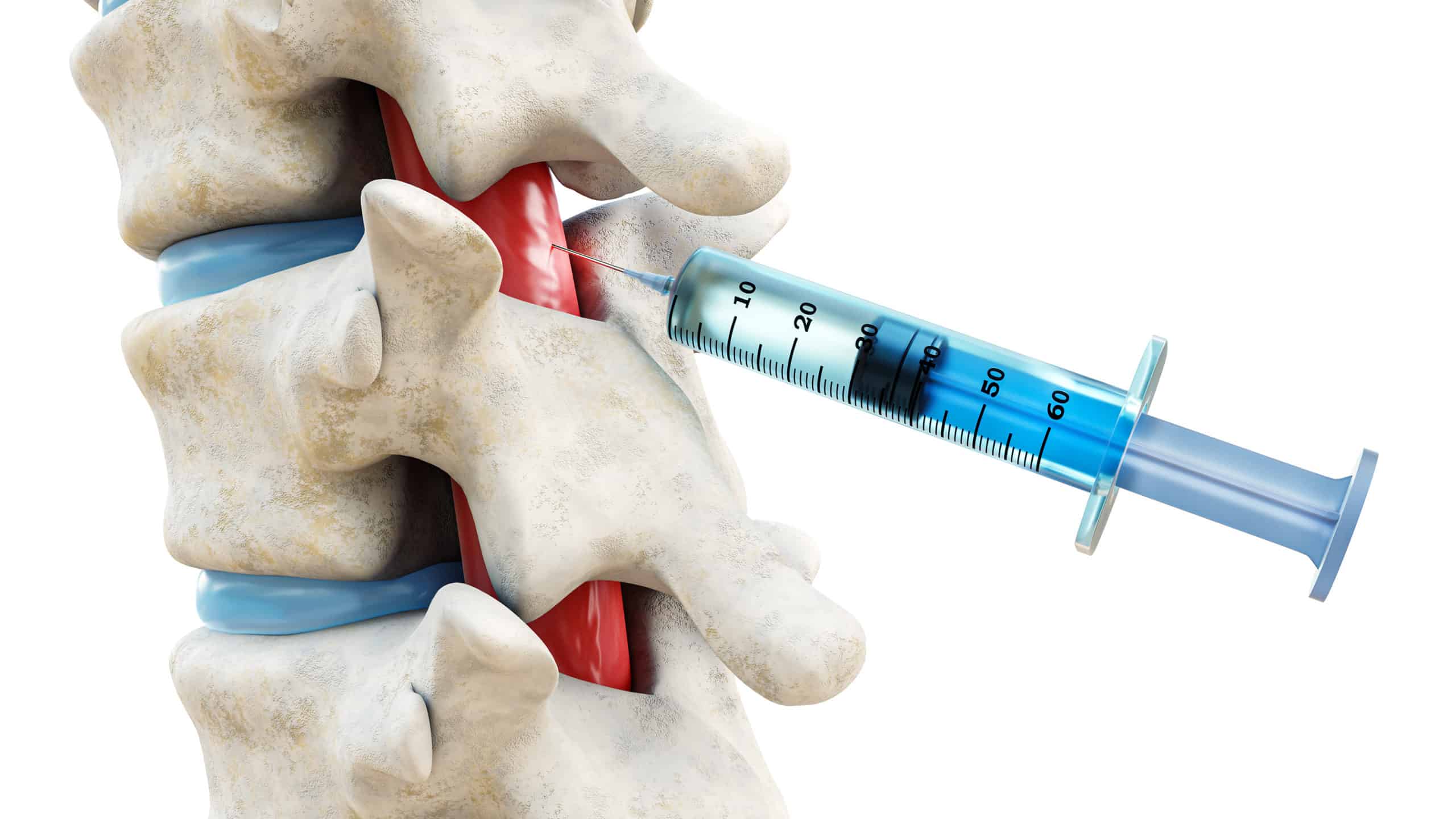 Epidural Injection In NJ Northeast Spine And Sports Medicine