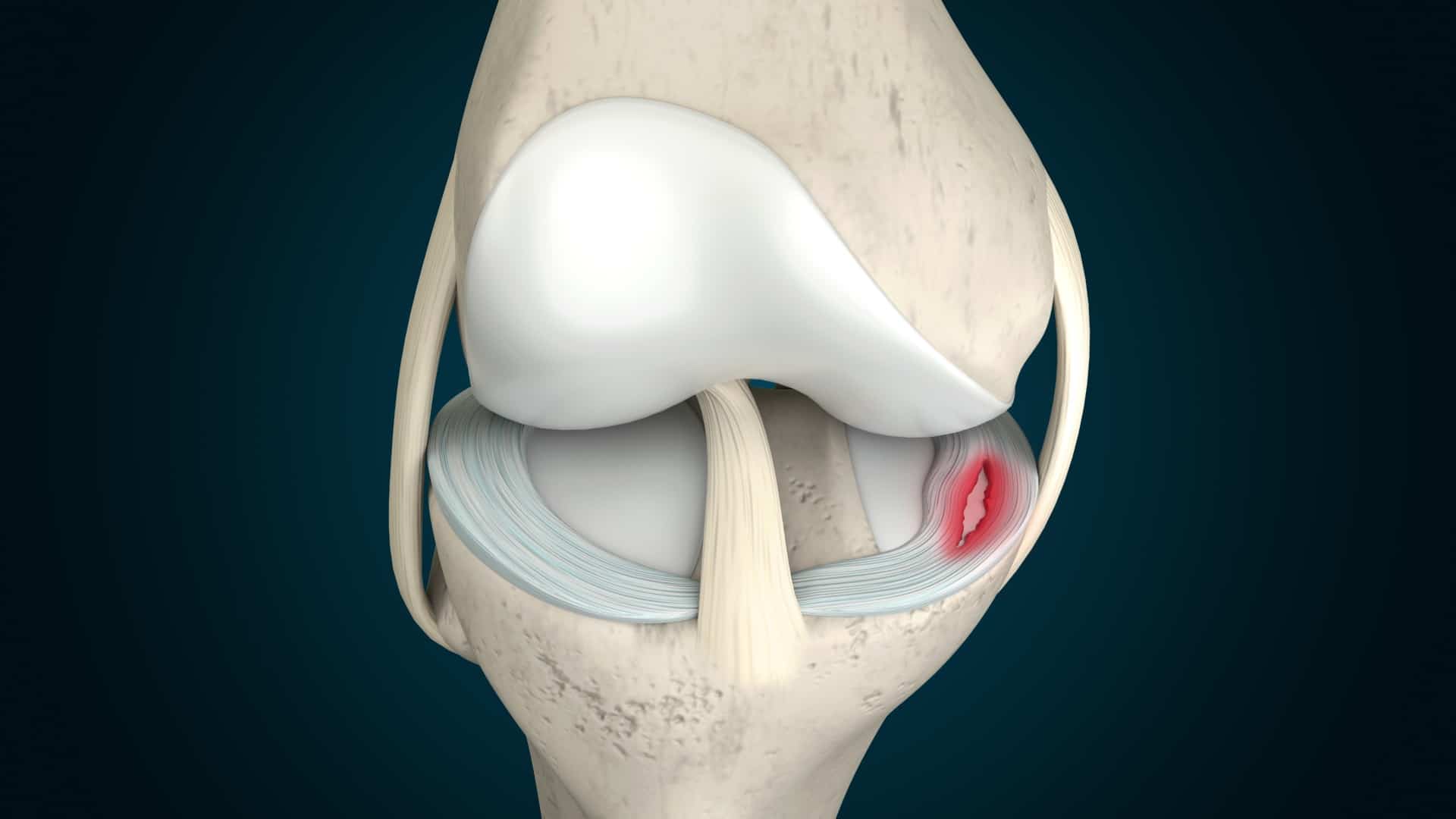 What Is A Meniscus Tear How Can I Treat It NorthEast Spine 